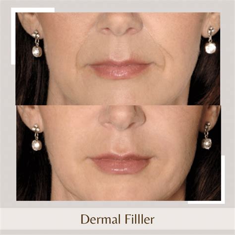 Dermal Fillers in Gold Coast • Check Prices & Reviews.